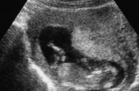 Première française : un enfant atteint d’un spina bifida opéré in utéro